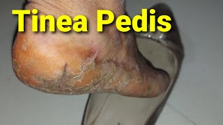 Fungal Infection of Feet Tinea Pedis [upl. by Elleneg]