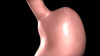 Gastric Bypass animation [upl. by Bach]