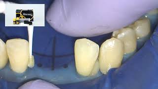 Noninvasive direct resin composite bridge restoration [upl. by Naitsirt79]