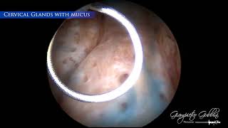 Clinical case Endocervical Ablation with GUBBINI MiniHysteroResectoscope by Dr Gubbini [upl. by Scammon86]