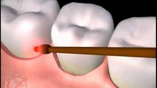 LANAP Laser Gum Treatment Philadelphia from Implant Dentist Dr Stephen Brown [upl. by Aiouqahs56]