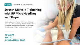 EndyMed RF Microneedling and Shaper 2nd Treatment for Stretch Marks  Body Tightening [upl. by Fougere]