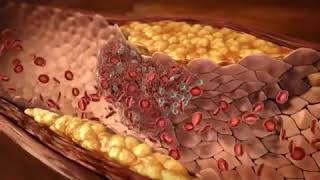 Pathogenesis of Atherosclerosis [upl. by Anauqes]