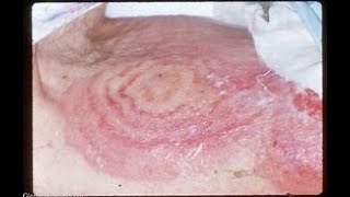 ERYTHEMA IN MEDICINE 1 [upl. by Alcine120]