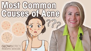 The Main Causes of Acne amp How To Combat Acne Prone Skin  GLOWBIOTICS [upl. by Camel942]