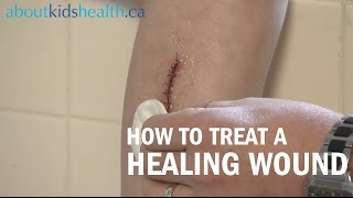 How to care for a healing wound  AboutKidsHealth at The Hospital for Sick Children [upl. by Enellij]