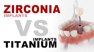 Zirconia Implants VS Titanium Implants  Aria Dental  Maryam Horiyat DDS [upl. by Jilleen]