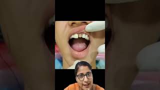 CERAMIC CROWN FOR A DISCOLORED TOOTH  shortsfeed toothdental youtubeshorts ASd dental viral [upl. by Harve]