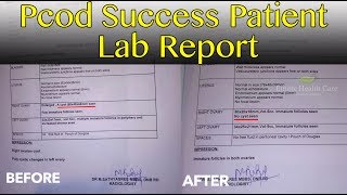 PCOD  PCOS  Vima Successful Patient Lab Reports And Review  Ethnic Health Care  DrBYoga Vidhya [upl. by Jodoin479]