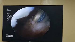 Arthrex Fibre tape internal braceArthroscopic ACL reconstruction Alhamdulillah [upl. by Faria]