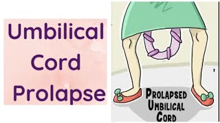 Umblical Cord Prolapse  Obstetric Emergencies [upl. by Hosbein256]