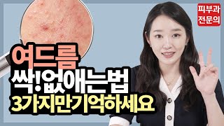 여드름 싹 없애는 스킨케어 이 3가지만 기억하세요 l 여드름 스킨케어 l 피부과 여드름 l [upl. by Arit]