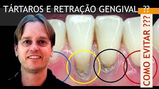 Tenho Retração Gengival e Tártaro Nos Dentes  Técnica Ninja 20 Para EVITAR EM CASA [upl. by Yleme]