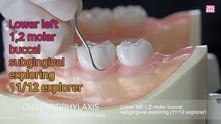 Lower left 12 molar buccal subgingival exploring 1112 explorer [upl. by Ahsiket]