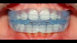 Interceptive Orthodontics [upl. by Asiilanna]