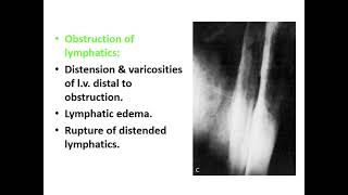 Lymphatic filariasis [upl. by Ecineg]