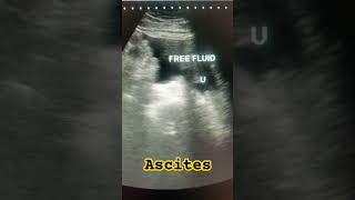 Ascites ultrasound abdomen ascites medical study shortfeed shortsviral hepatitisc ytviral [upl. by Einna]