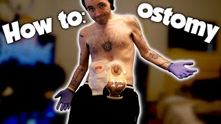 CHANGING MY OSTOMY BAG [upl. by Sualk]