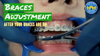 How Do Braces Straighten Teeth [upl. by Prissie517]