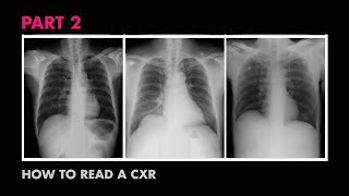 ABCs of Reading a Chest Xray  How to Read a Chest XRay Part 2  MEDZCOOL [upl. by Silletram789]