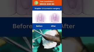 Circumcision surgery Stapler PhimosisSwollen Penis Treatment hospital doctor hyderabad [upl. by Einotna]