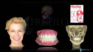 Bimaxillary Orthognathic Facial Cosmetic Plastic Jaw Surgery [upl. by Hadihahs]