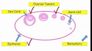 12DaysinMarch Ovarian Tumors for USMLE Step One [upl. by Redneval]