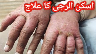 psoriasis treatmentskin allergypsoriasis signpsoriasis [upl. by Odama241]