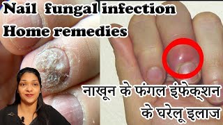 Paronychia treatment home remedies in hindi How to cure Nail fungus  Onychomycosis [upl. by Kaczer]