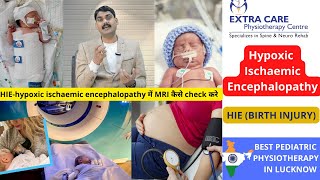 Hypoxic Ischaemic Encephalopathy  HIE in Babies Birth Injury  Pediatric Physiotherapy in Lucknow [upl. by Ninetta]