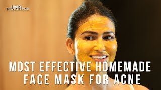 Most Effective Homemade Face Mask for Acne  How to Get Rid Of Acne amp Acne Scars [upl. by Eceinehs535]