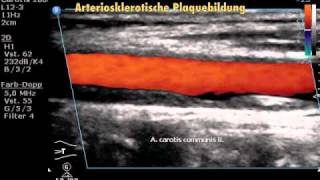 Farbduplexsonographie der Halsschlagader Arteria carotis [upl. by Fassold]