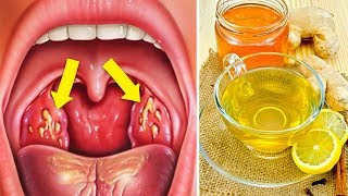 How to Cure Tonsillitis Fast and Naturally [upl. by Marler]