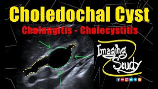 Choledochal Cyst with Cholangitis amp cholecystitis  Ultrasound  Case 272 [upl. by Cran]