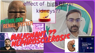 MALIGNANT NEPHROSCLEROSISEFFECT OF ACCLERATED HYPERTENSION ON KIDNEY PART 22  NEPHROLOGY [upl. by Rattan828]