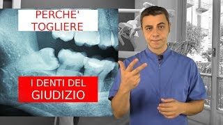 Perché togliere i denti del giudizio [upl. by Enyad39]