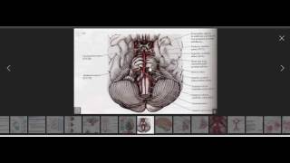 MRI discussion on Pontine Stroke [upl. by Atinit]