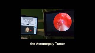 surgery for gh secreting adenoma in patient with mccune albright syndrome with fibrous dysplasia [upl. by Notsa91]