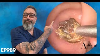 The MOST SATISFYING ring of dry ear wax removal EP989 [upl. by Hareehat]