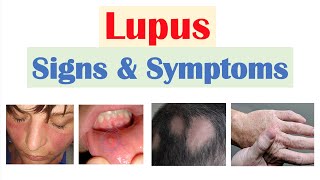 Lupus Signs amp Symptoms amp Why They Occur  Skin Joints Organ Systems [upl. by Nomyt148]