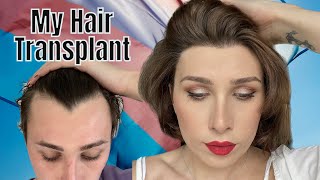 My hair transplant journey Trans Woman [upl. by Ilojna]