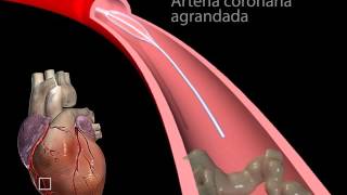 Angioplastia con balón segmento corto  Medicina y Cirugia [upl. by Luna]