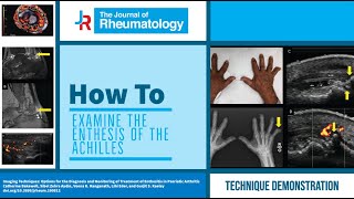 How to Examine the Enthesis of the Achilles [upl. by Schertz32]