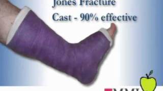 Dr Frank Nisenfeld at MMI  Jones Foot Fracture [upl. by Marco]