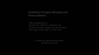 Unilateral Tongue Atrophy and Fasciculation [upl. by Anitroc]