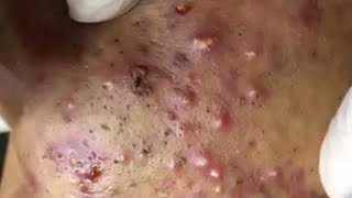 Inflammation Itching pustule and Toxic blood sucking of acne Part100 KD Acne Treatment [upl. by Valleau]