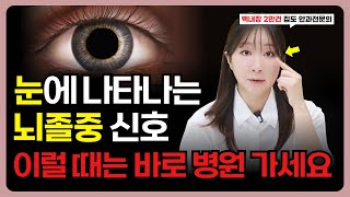 눈에 생기는 뇌졸중 신호 이럴 때는 바로 병원으로 뛰어 가세요 눈 건강 이상 신호 8가지 [upl. by Analim]