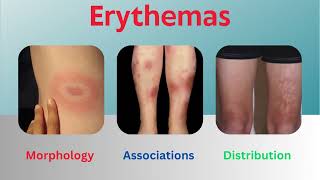 Erythemas Uncovered Insights into Morphology Associations and Distribution [upl. by Iroak876]