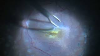 Epi Retinal gliosis Removal [upl. by Otokam196]