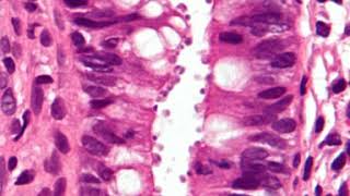 Cryptosporidiosis  Wikipedia audio article [upl. by Ric]